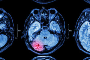 MRI scan of a traumatic brain injury
